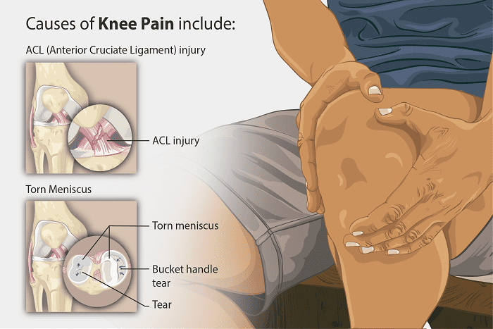 Knee Ligament Sprains